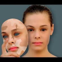 विटिलिगो का कैसे करे उपचार